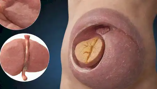 ilustración 3D de un cuerpo humano con una cavidad abdominal abierta rebanada que muestra capas de células grasas viscerales, un acercamiento de una molécula de glucosa que interactúa con un receptor de insulina, y un fondo de una vía metabólica con enzimas y hormonas implicadas en la glucolisis, la glucogénesis y la lipogénesis