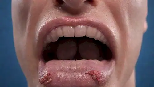 ilustración 3D de una lengua humana con superficie granular, papilla inflamada y brotes de sabor roto, rodeado de débiles tonalidades rojas y azules para transmitir irritación e incomodidad