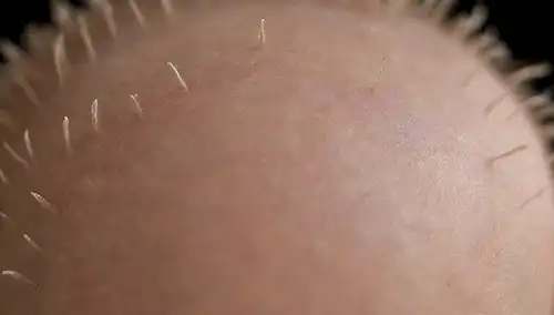ilustración 3D de un cuero cabelludo de mujeres con múltiples pequeños agujeros, micro-necedles insertados en folículo del cabello, vista de cerca del crecimiento del cabello regenerador, proceso de tratamiento suave, luz natural filtrante