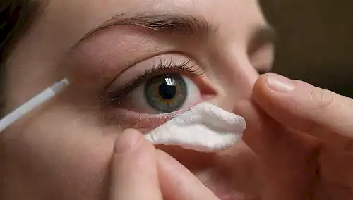 Un disparo de cerca de un par de manos que sostienen una gasa estéril, un hisopo de algodón, y un gotero de ojos; en el fondo, una representación borrosa de un ojo inflado, con lágrimas o descarga que engalan la mejilla; una iluminación cálida y suave para transmitir un sentido de cuidado y atención